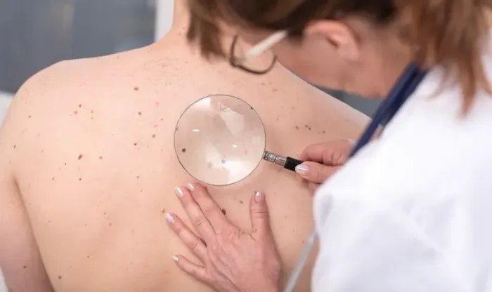 Skin Cancer Your Ultimate Guide to Spotting Signs and Preventing It